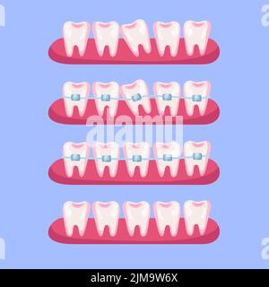 Denti prima e dopo bretelle cartoon set illustrazione. Fasi di allineamento dentale o trattamento con l'uso di staffe per un sorriso bello. Ortodonti Illustrazione Vettoriale