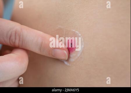 Una donna spalma la crema su una ferita dopo aver bruciato una verruca. Foto Stock