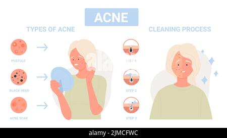 Tipo di acne sulla pelle facciale, passi di trattamento di infezione per l'illustrazione infografica del vettore piatto dei pori del viso. Ragazza cartoon con derma problema di infiammazione, cicatrici. Medicina, concetto di cura della pelle Illustrazione Vettoriale