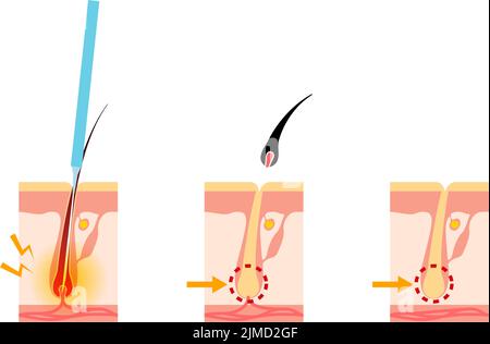 Immagine della rimozione dei capelli, il processo di rimozione dei capelli dopo il trattamento di rimozione dei capelli con ago Illustrazione Vettoriale