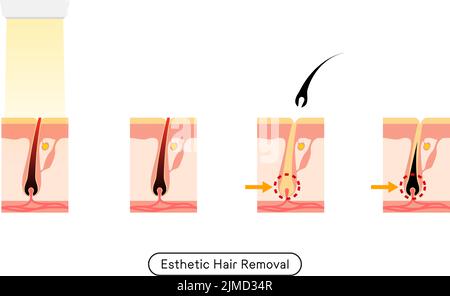 Immagine della rimozione dei capelli, il processo di rimozione dei capelli dopo il trattamento estetico di rimozione dei capelli Illustrazione Vettoriale