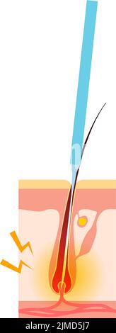 Immagine della rimozione dei capelli, il processo di rimozione dei capelli dopo il trattamento di rimozione dei capelli con ago Illustrazione Vettoriale