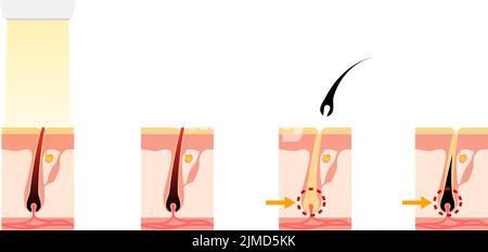 Immagine della rimozione dei capelli, il processo di rimozione dei capelli dopo il trattamento estetico di rimozione dei capelli Illustrazione Vettoriale