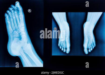 Raggi X del piede umano e coppia di piedi da diverse viste Foto Stock