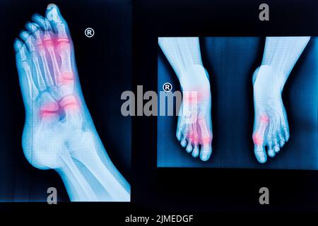 Raggi X del piede umano e coppia di piedi da diverse viste Foto Stock