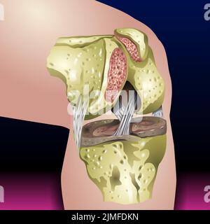 Dolore alle ossa, lesione e infiammazione, dolore alle articolazioni del ginocchio icona della silhouette Ache del ginocchio, scheletro delle gambe, artrite, osteoporosi e articolazioni delle ossa, illustrazione Foto Stock