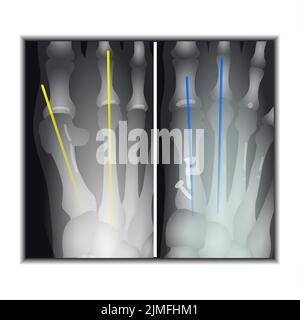 Raggi X dell'arpice del piede Foto Stock