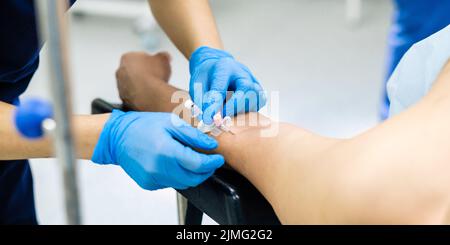 Posizionamento di un catetere nel braccio del paziente Foto Stock