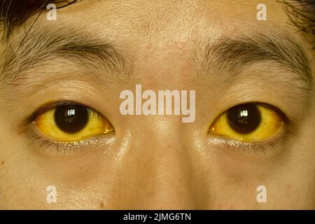 Ittero profondo in pazienti asiatici maschi. Colorazione giallastra della pelle e della sclera. Iperbilirubinemia. Epatite acuta. Foto Stock