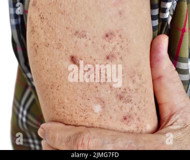 Macchie di età e macchie bianche sul braccio dell'anziano asiatico. Queste macchie di età sono marrone, grigio, o macchie nere e anche chiamato macchie di fegato, lentigo senile, così Foto Stock