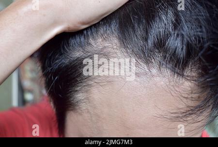 Diradamento o capelli sparsi, maschio modello perdita di capelli nel sud-est asiatico, cinese giovane uomo. Foto Stock