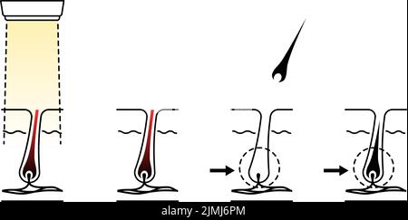 Immagine della rimozione dei capelli, il processo di rimozione dei capelli dopo il trattamento estetico di rimozione dei capelli Illustrazione Vettoriale