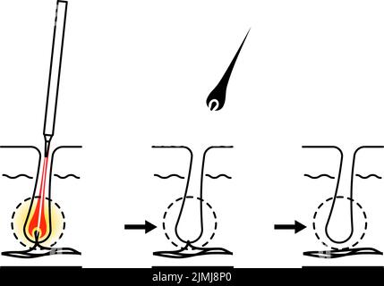 Immagine della rimozione dei capelli, il processo di rimozione dei capelli dopo il trattamento di rimozione dei capelli con ago Illustrazione Vettoriale