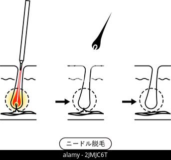 Immagine della rimozione dei capelli, il processo di rimozione dei capelli dopo trattamento di rimozione dei capelli dell'ago - traduzione: Rimozione dei capelli dell'ago Illustrazione Vettoriale