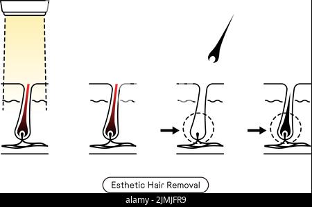 Immagine della rimozione dei capelli, il processo di rimozione dei capelli dopo il trattamento estetico di rimozione dei capelli Illustrazione Vettoriale