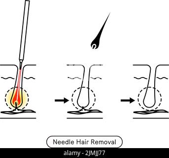 Immagine della rimozione dei capelli, il processo di rimozione dei capelli dopo il trattamento di rimozione dei capelli con ago Illustrazione Vettoriale