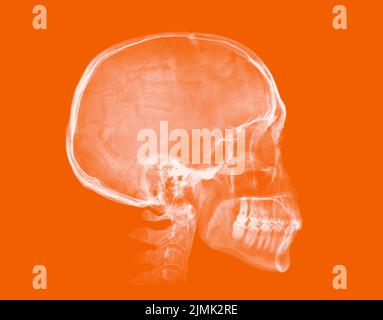 Cranio umano. Immagine radiografica su sfondo arancione Foto Stock