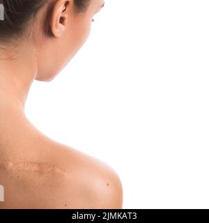 Donna con una cicatrice sulla sua spalla Foto Stock