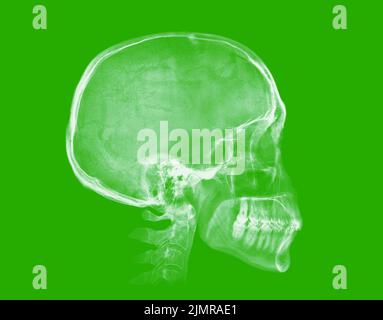 Cranio umano. Immagine radiografica su sfondo verde Foto Stock