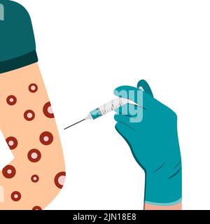 Vaccinazione contro il virus della scimmia nella spalla e nel braccio con una siringa. Eruzione sul corpo. Virus della varicella scimmia sintomi sulla mano rash Illustrazione Vettoriale