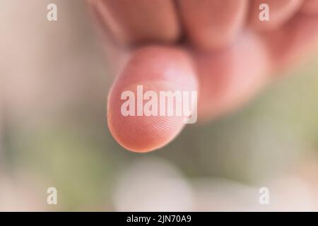 Il primo piano delle dita sulla mano è gravemente bruciato Foto Stock