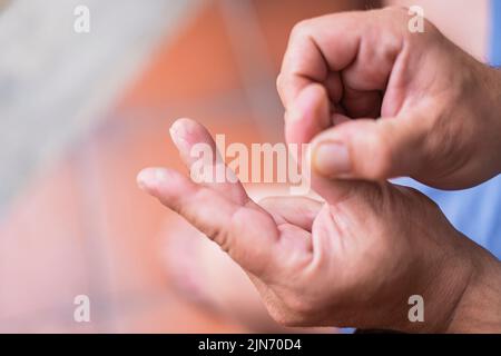 Il primo piano delle dita sulla mano è gravemente bruciato Foto Stock