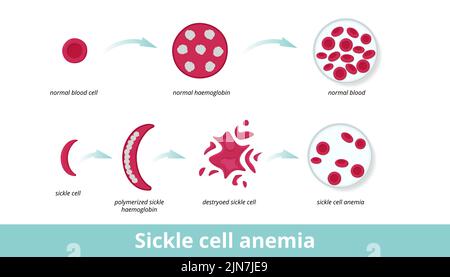 Anemia falciforme (malattia) si verifica a causa di cellule falciformi appiccicose emoglobina falciforme polimerizzata a lungo danneggiata che distorce la forma circolare degli eritrociti. Illustrazione Vettoriale