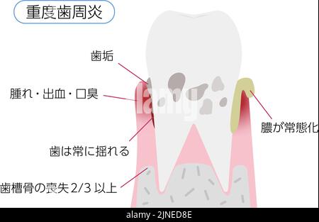 Illustrazione per fase della malattia parodontale: Parodontite grave traduzione: Parodontite grave, placca, gonfiore / sanguinamento / respiro cattivo, denti Illustrazione Vettoriale