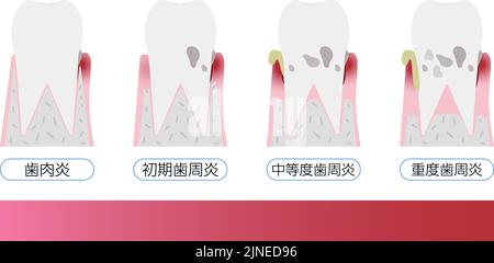 Illustrazione per stadio della malattia parodontale: Ordine di avanzamento traduzione: Gengivite, parodontite precoce, parodontite moderata, parodontite grave Illustrazione Vettoriale