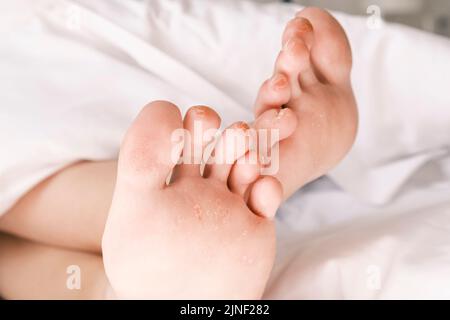 Corni e micosi. Primo piano dei piedi delle donne con calli su ogni dito. Cracking della pelle sulle gambe, infiammazione e arrossamento. Problemi della pelle Foto Stock