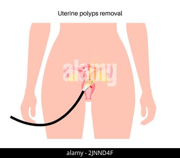 Polipi uterini, illustrazione Foto Stock