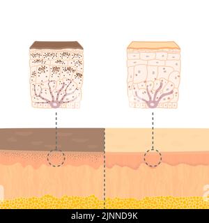 Pigmentazione cutanea, illustrazione Foto Stock