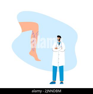 Trattamento venoso varicoso, illustrazione Foto Stock