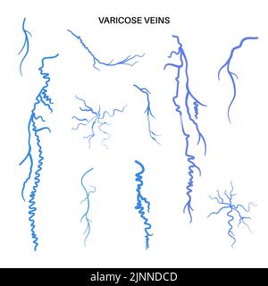 Vene varicose, illustrazione Foto Stock