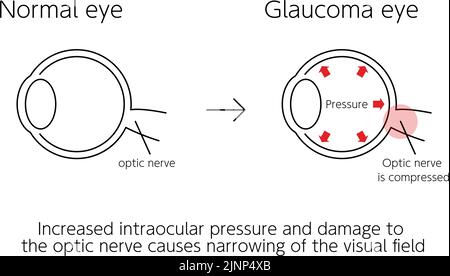Illustrazione di come funziona il glaucoma, occhi normali e glaucomati, illustrazione medica Illustrazione Vettoriale