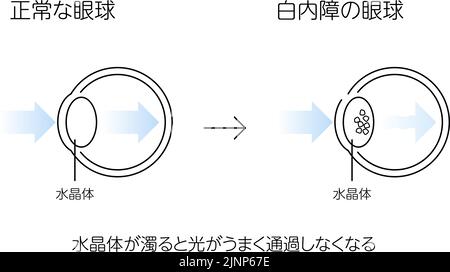 Occhio normale e cataratta, illustrazione (disegno a linee) - traduzione: Occhio normale, occhio cataratta, lente, la luce non può passare attraverso la lente correttamente Illustrazione Vettoriale