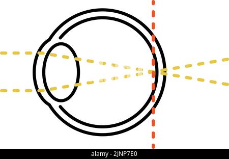 Illustrazione medica dell'acutezza visiva e dell'errore rifrattivo, ortopia (focus at the retina) Illustrazione Vettoriale