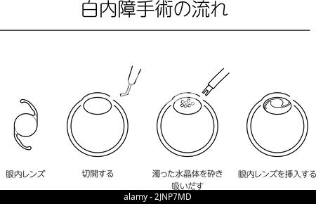 Flusso di chirurgia della cataratta, illustrazione illustrata (disegno a linee) - traduzione: Flusso di chirurgia della cataratta, lente intraoculare, incisione, aspirazione Illustrazione Vettoriale