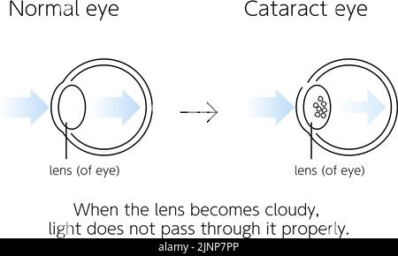 Occhio normale e cataratta, illustrazione (disegno a linee) Illustrazione Vettoriale