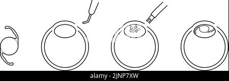 Flusso della chirurgia della cataratta, illustrazione illustrata (disegno a linee) Illustrazione Vettoriale