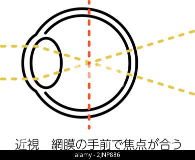 Illustrazioni mediche di visione ed errori di rifrazione, di Myopia (focus in front of the retina) - traduzione: Miopia (focus in front of the retina) Illustrazione Vettoriale