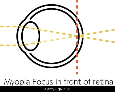 Illustrazione medica dell'acutezza visiva e dell'errore rifrattivo, ortopia (focus at the retina) Illustrazione Vettoriale