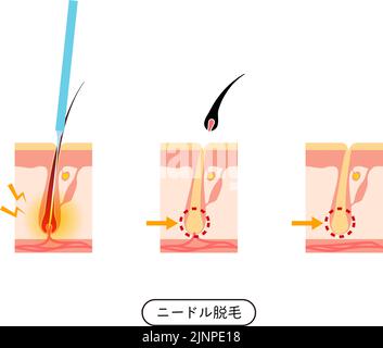 Immagine della rimozione dei capelli, il processo di rimozione dei capelli dopo trattamento di rimozione dei capelli dell'ago - traduzione: Rimozione dei capelli dell'ago Illustrazione Vettoriale