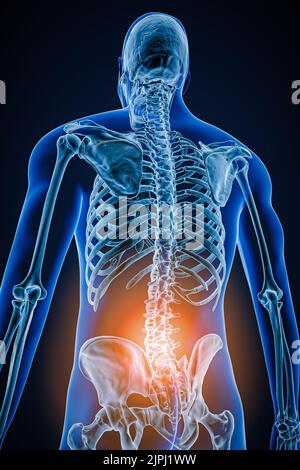 Vista posteriore o posteriore della colonna vertebrale o della colonna vertebrale umana con infiammazione o lesione 3D illustrazione del rendering. Patologia, dolore alla spina dorsale, anatomia, lumba Foto Stock