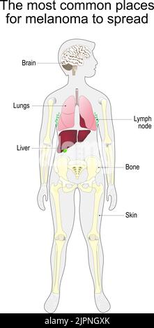 metastasi del cancro della pelle melanoma maligno. I luoghi più comuni per la diffusione del melanoma. Diagramma vettoriale Illustrazione Vettoriale