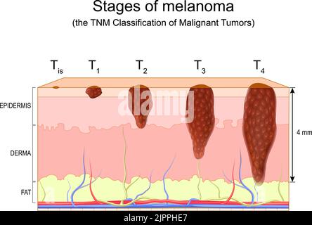 fasi di melanoma. Classificazione TNM dei tumori maligni. Metastasi del cancro della pelle. Melanoma maligno. Diagramma vettoriale Illustrazione Vettoriale