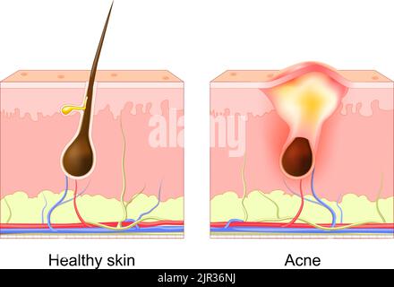 Pimple dell'acne. Follicolo normale dei capelli e poro ostruito. Differenza tra strato di pelle sana e acne. Diagramma dermatologico. Pimple dell'acne patch. Vettore Illustrazione Vettoriale