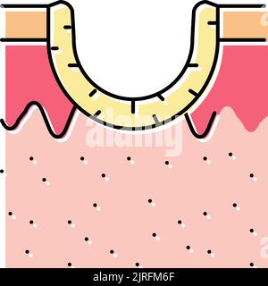 immagine vettoriale dell'icona di colore della cicatrice dell'acne di rotolamento Illustrazione Vettoriale
