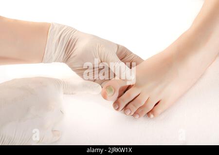 Doctor with white gloves, takes in his hands subungual hematoma in the nail. Onycectomy, isolated background white. Close up. Stock Photo