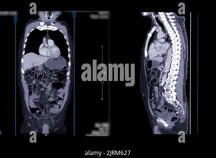 SCANSIONE TC della vista coronale e sagittale del torace e dell'addome con mezzo di contrasto per iniezione per la diagnosi delle malattie toraciche e addominali. Foto Stock